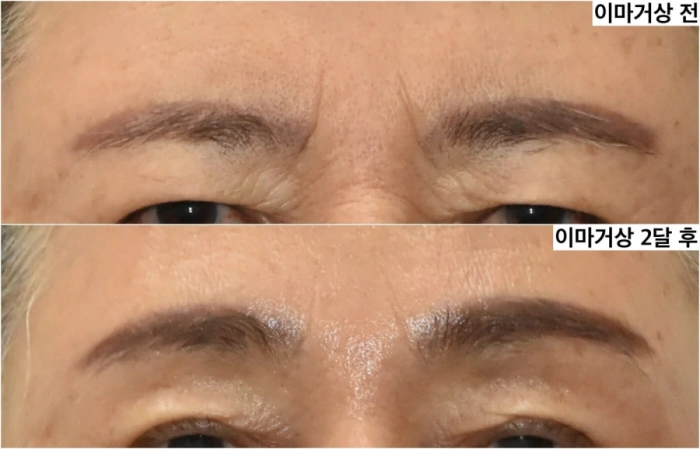 2month after forehead lift