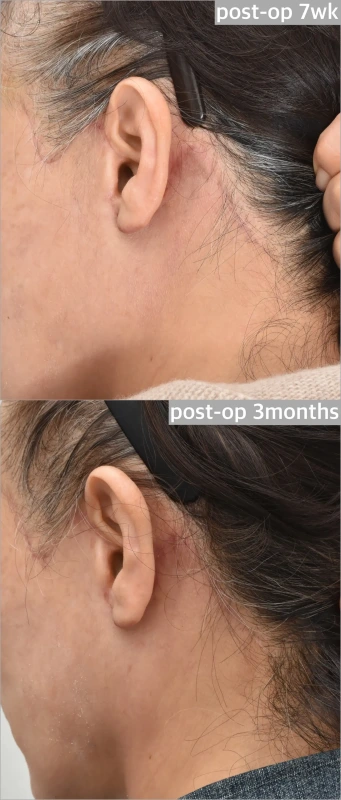 ندوب خلف الأذن بعد عملية شد الوجه بواسطة Noonopi