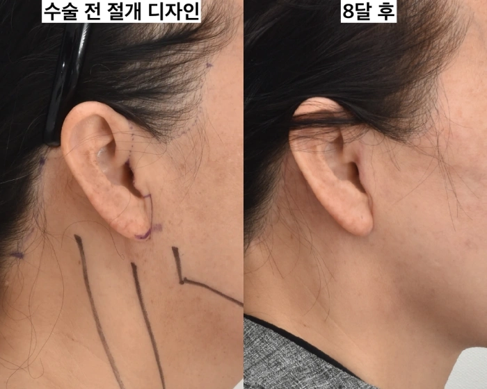 안면거상 절개선