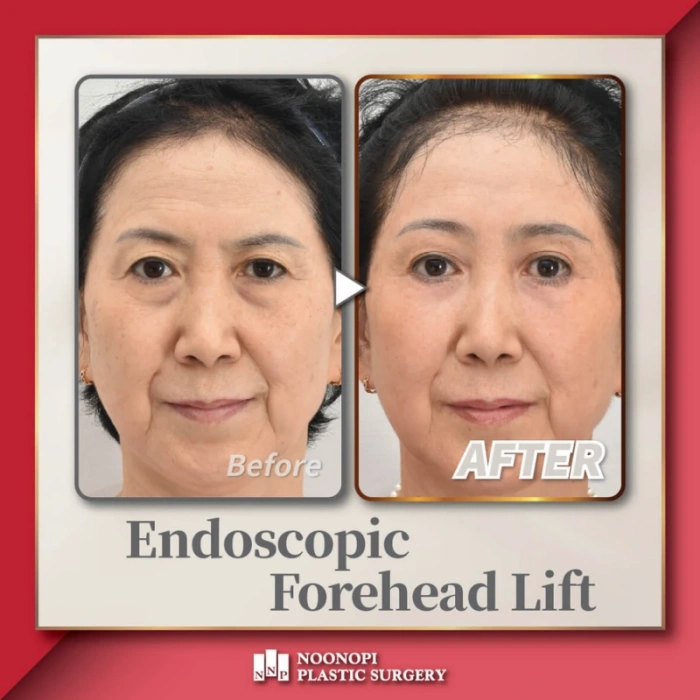 联合眉部提升、下睑成形术及上下眼睑脂肪移植的案例