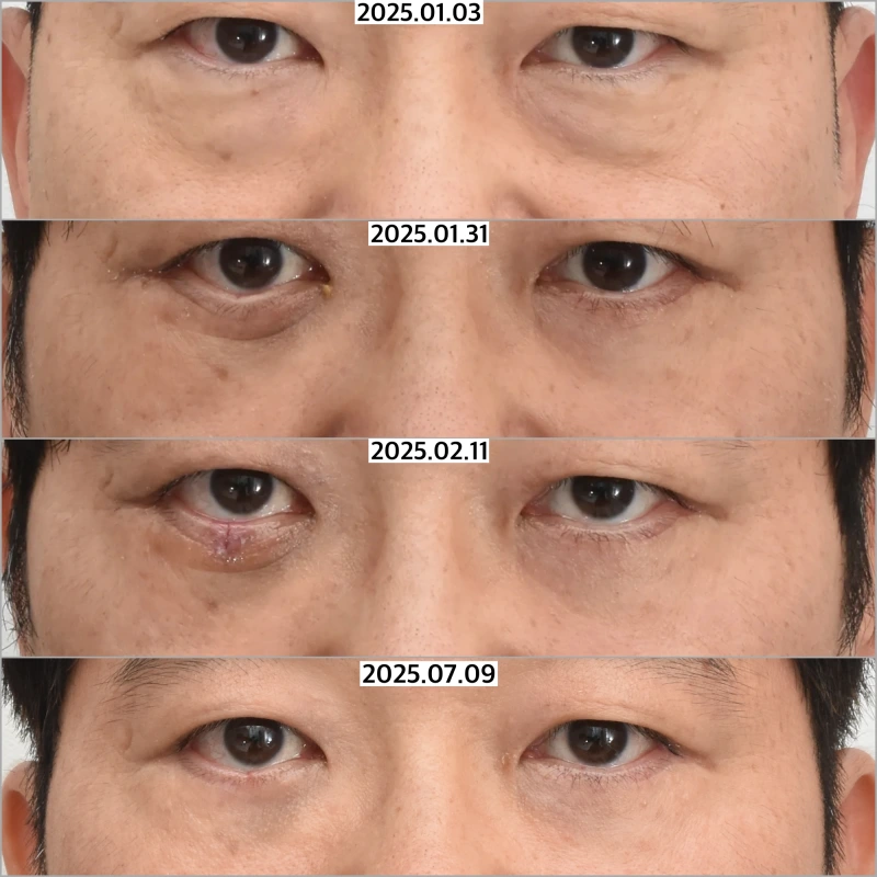 동공 중앙 부위의 안검외반과 이를 교정한 사례