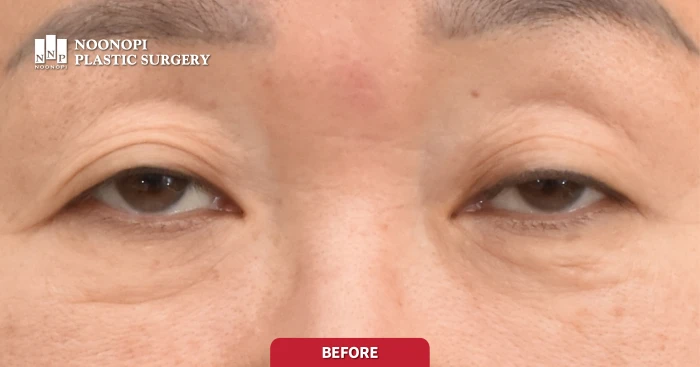asymmetric eyes correction at Noonopi Clinic, Before surgery