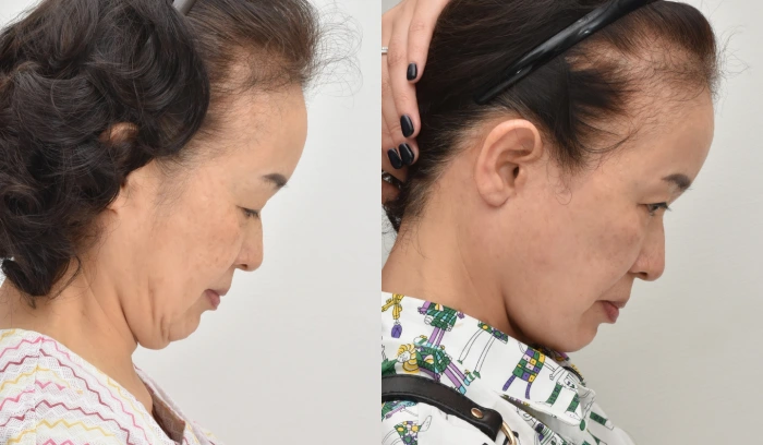 before after rhytidectomy korea