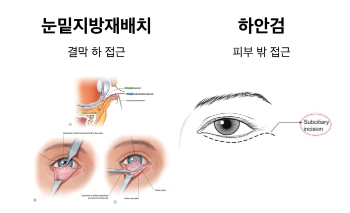 눈밑지방재배치와 하안검 비교 이미지
