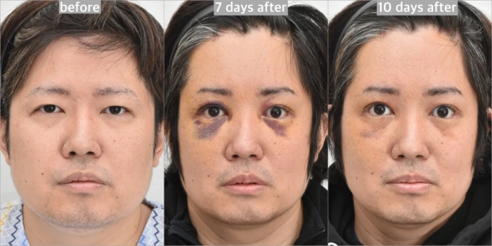 术后第7天实施消淤激光治疗以加速愈合