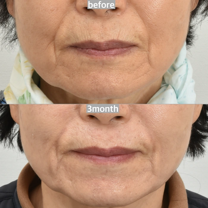 laser skin resurfacing before and after