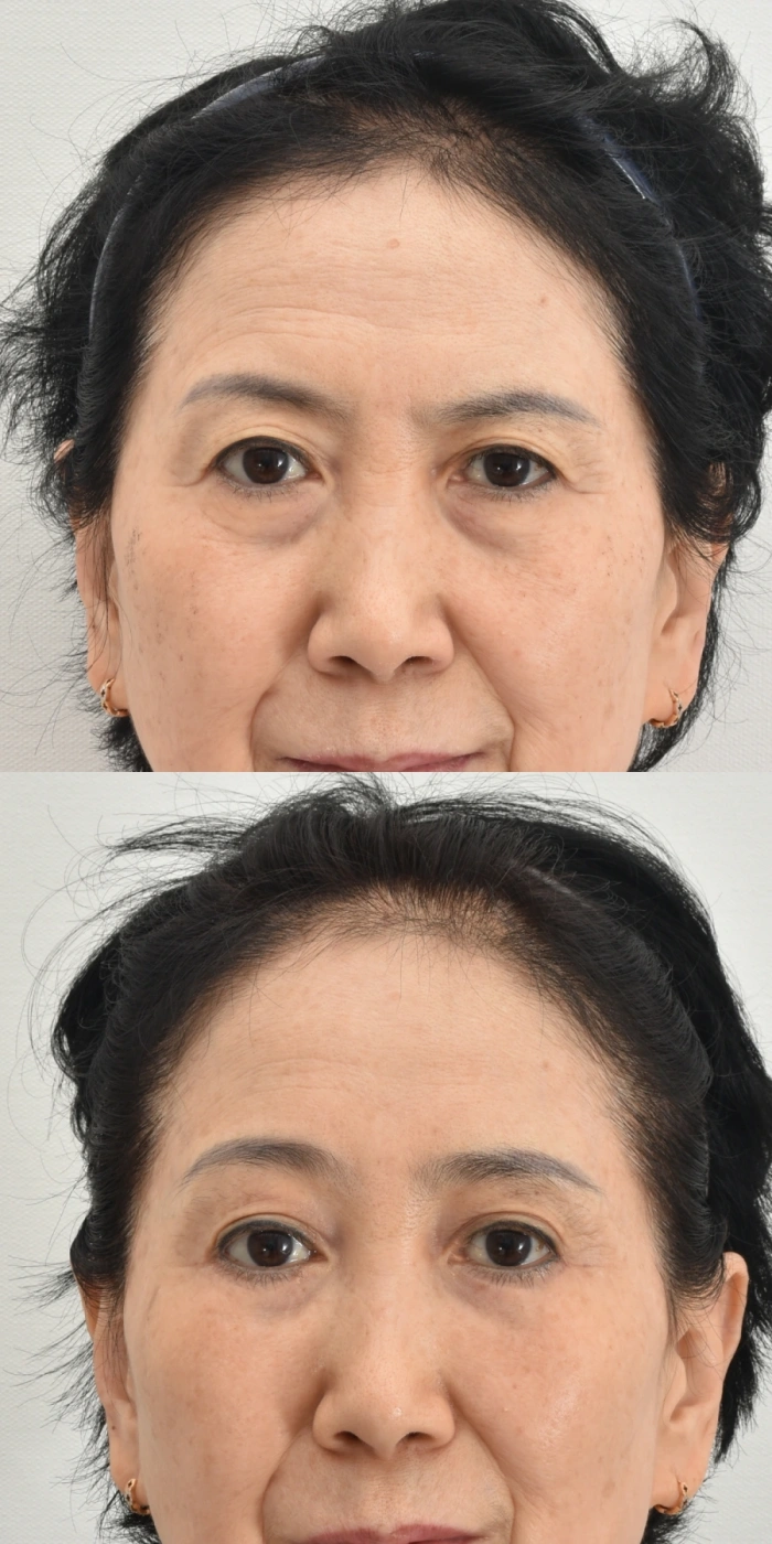 endoscopic brow lift before and after