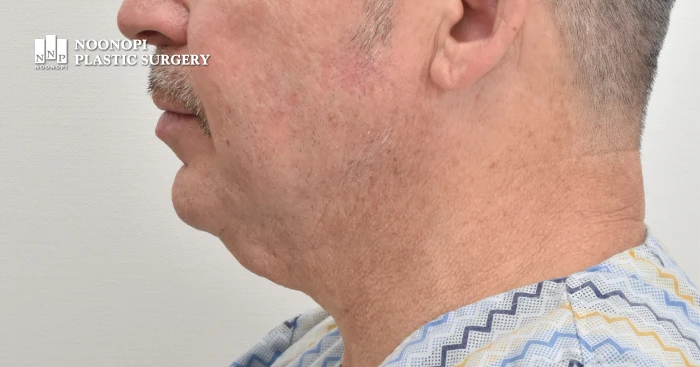 Pre-op view of Mini Neck Lift patient