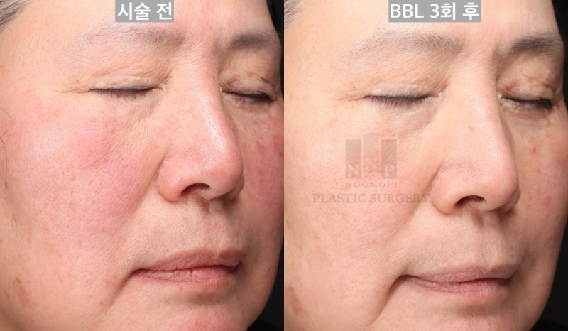 Rosacea before and after