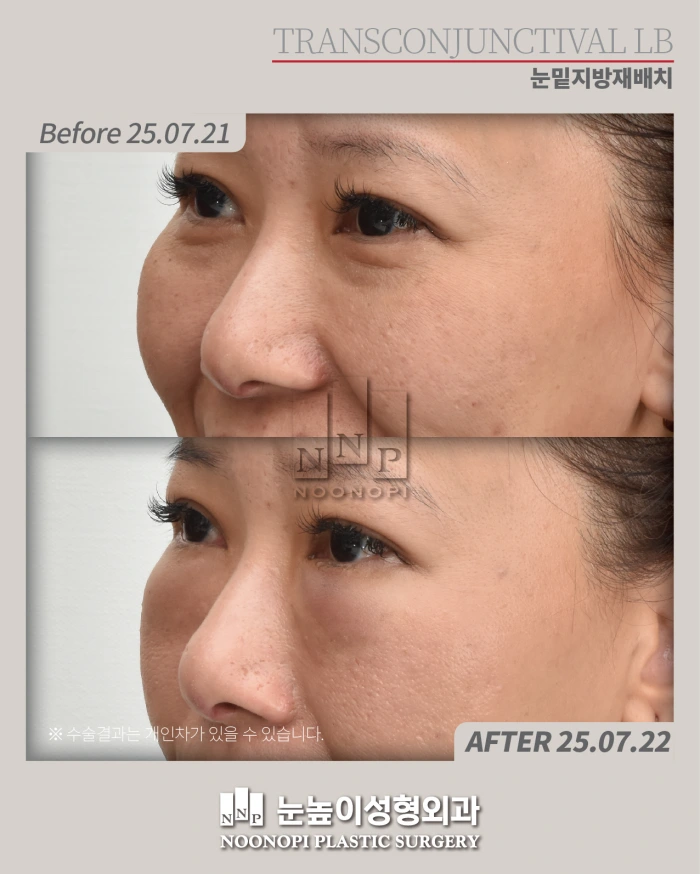 علاج الأكياس تحت العينين: بعد العملية بيوم واحد