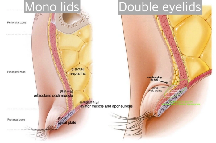 Anatomic difference of mono lids and double eyelids