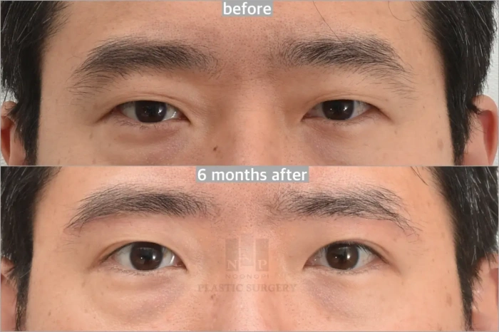 眉下提升术后6个月