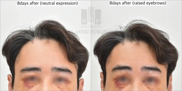 no nerve injury after brow lift in Korea