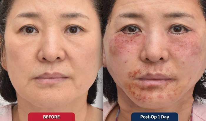 Remarkable healing effect of Rejuran skin booster after laser