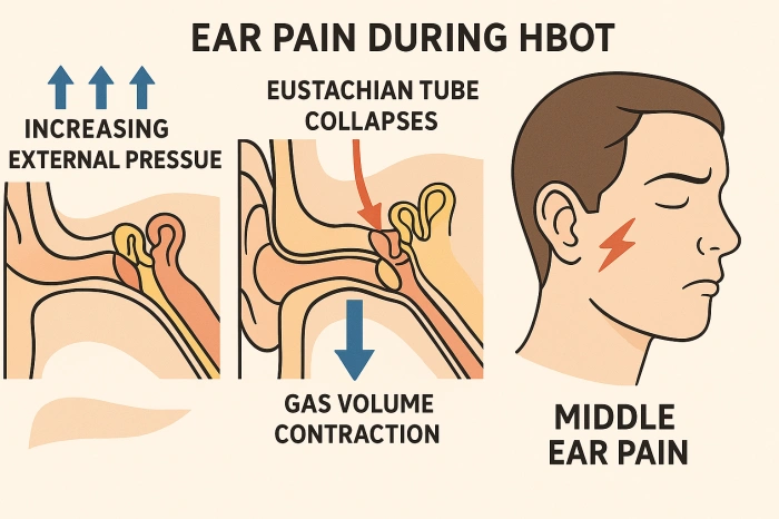 高压氧治疗对耳朵疼的人