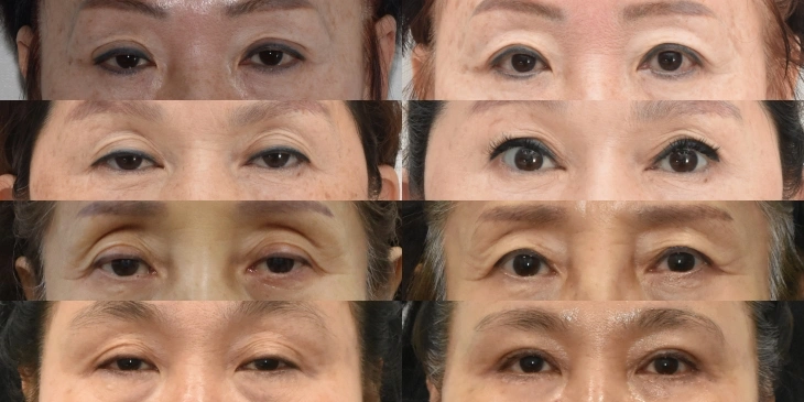 ptosis surgery before after in Aging patients