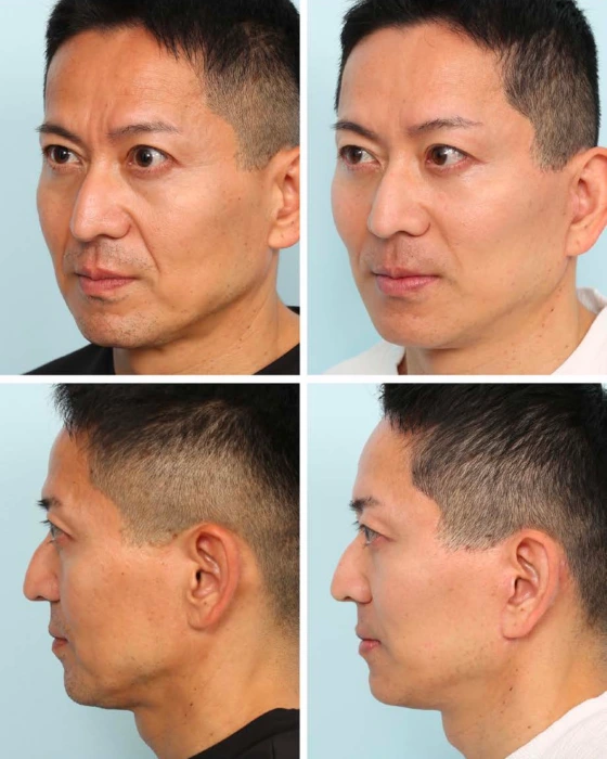 목거상을 하지 않고 안면거상만 시행한 싱가폴 의사의 전후 결과