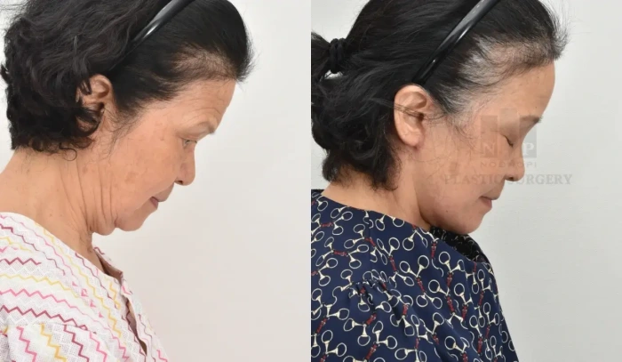 70岁患者颈部与面部联合提升术后效果
