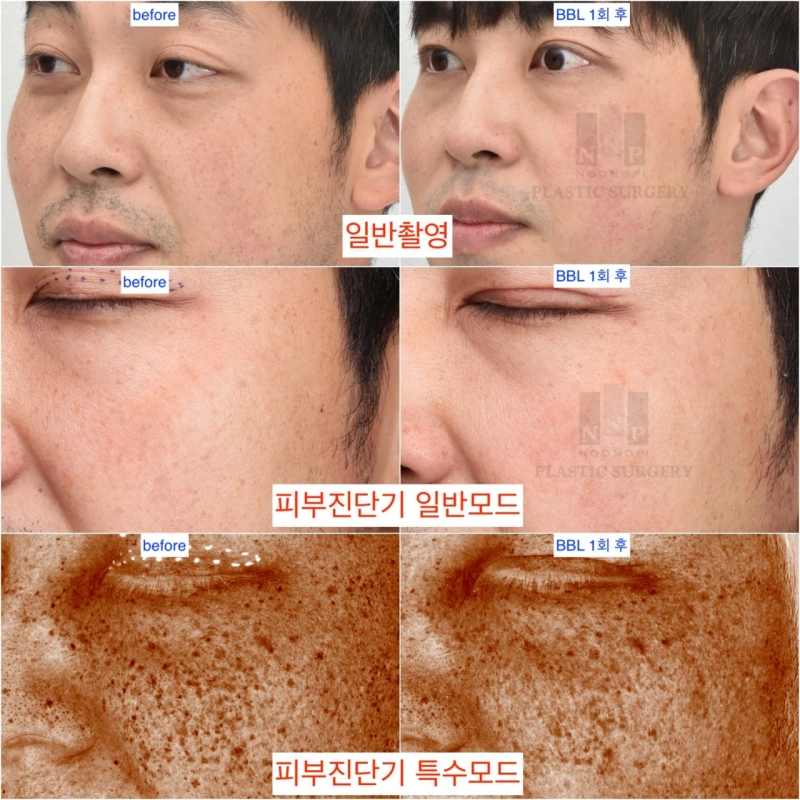 Sun spots treatment results