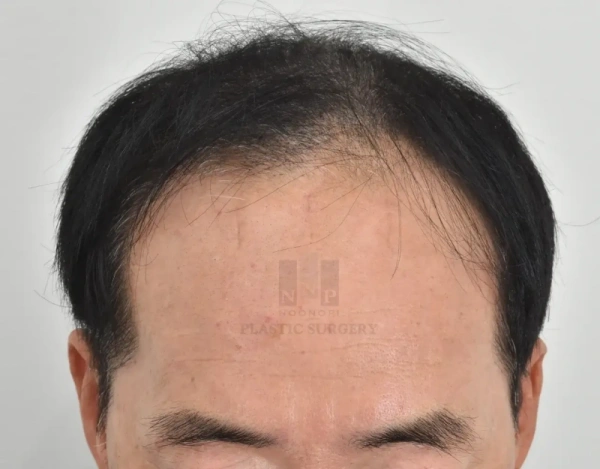 less visible scar after endoscopic forehead lift
