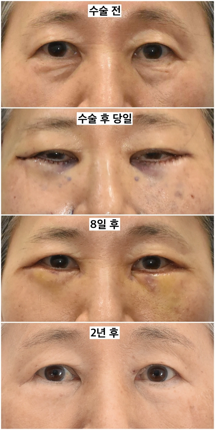 하안검 지방이식 병행 전후