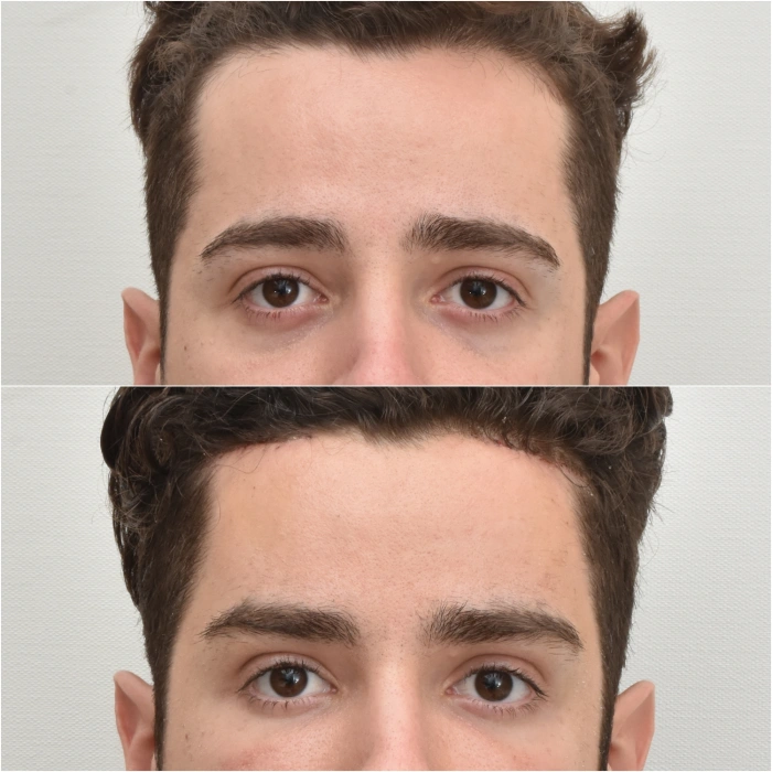 Male temporal brow lift before and after