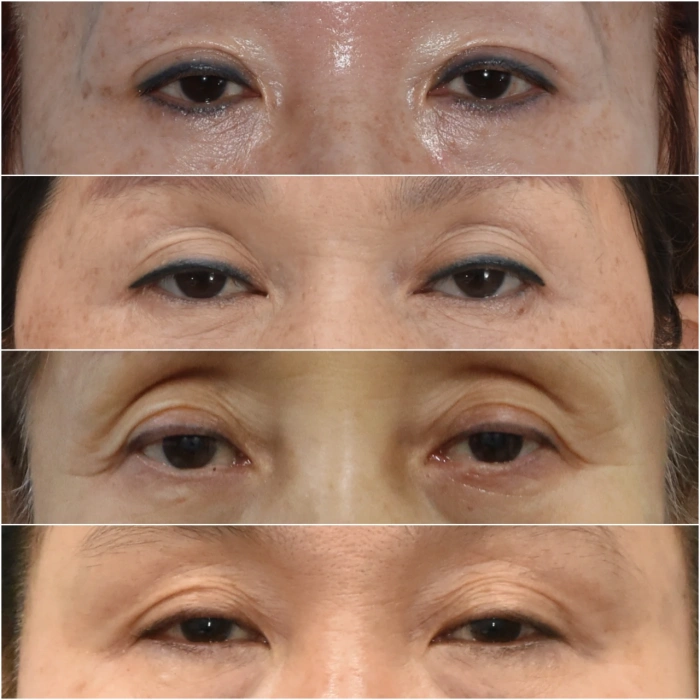 مثال على الجفن المترهل