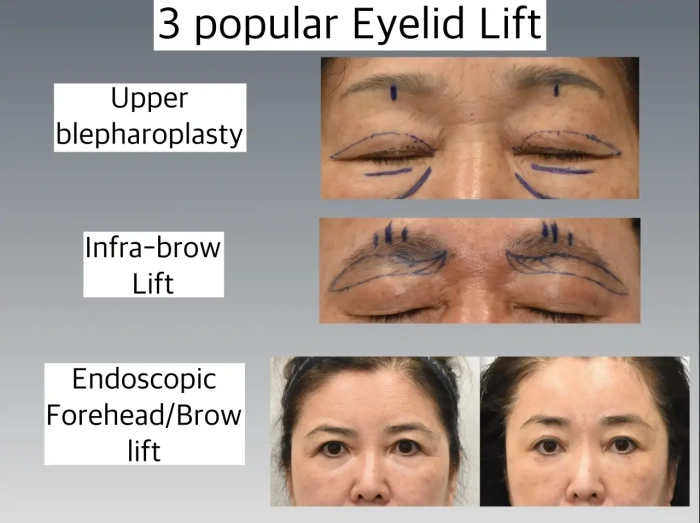 上睑成形术、眉下提升术与额部提升术对比示意图