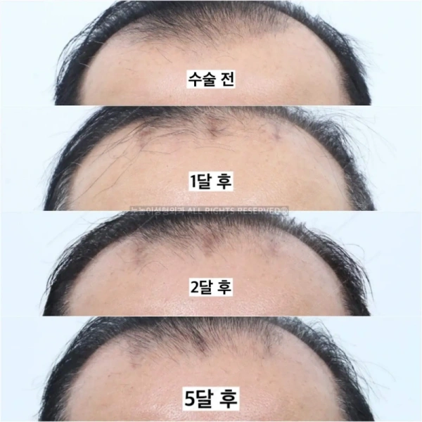 이마거상 대머리 사례