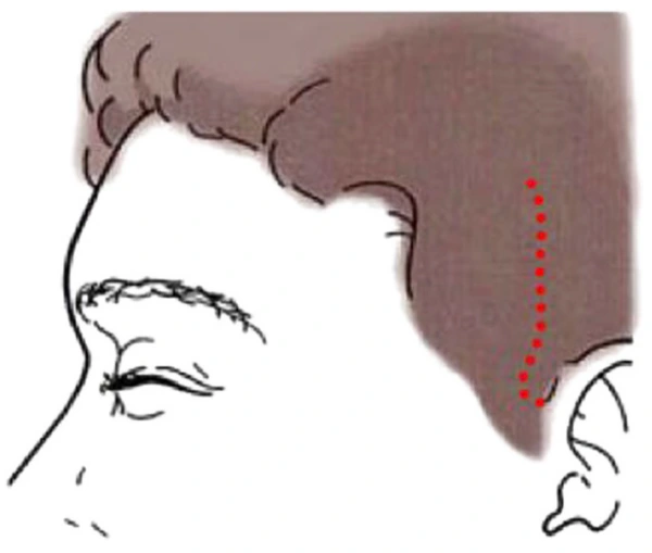 incision placement comparison in facelift