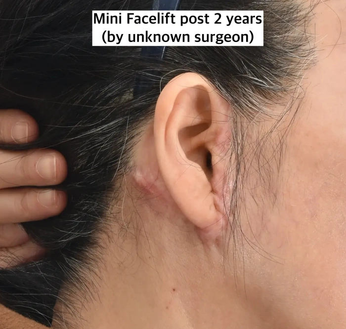 ندبات ما قبل الصوان التي تظهر بعد عملية شد الوجه المصغرة