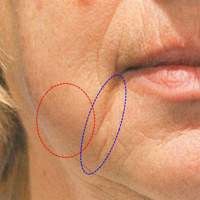 傀儡纹（蓝色）与下颌赘肉（红色）