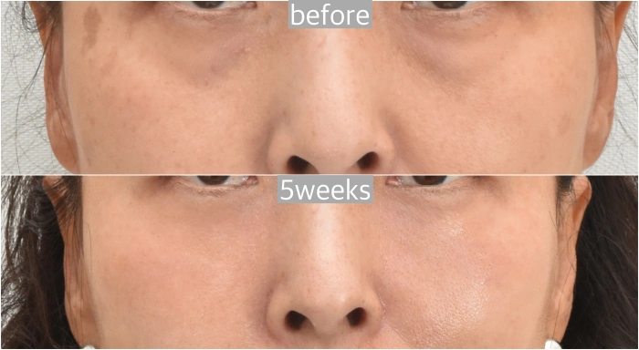 results of laser lower blepharoplasty