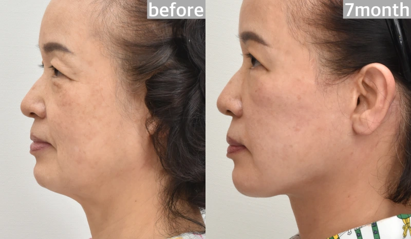 facelift incision location