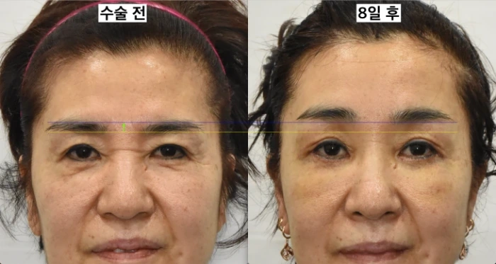 minimal invasive forehead lift