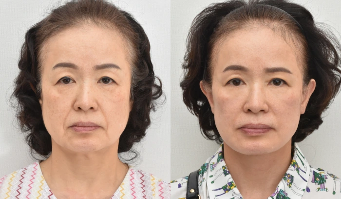 칼귀 없는 안면거상