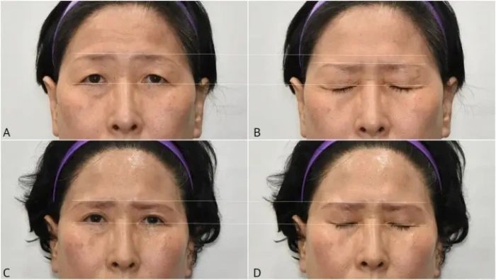 مضاعفات رفع الحاجب