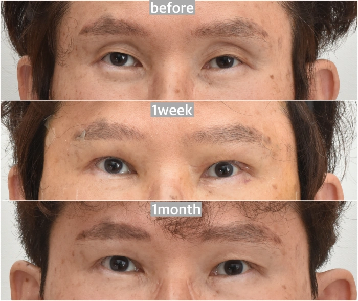 上睑成形术、眼睑下垂矫正、上睑及太阳区脂肪填充