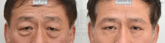 شد الحاجب السفلي وجراحة الجفن السفلي: قبل وبعد