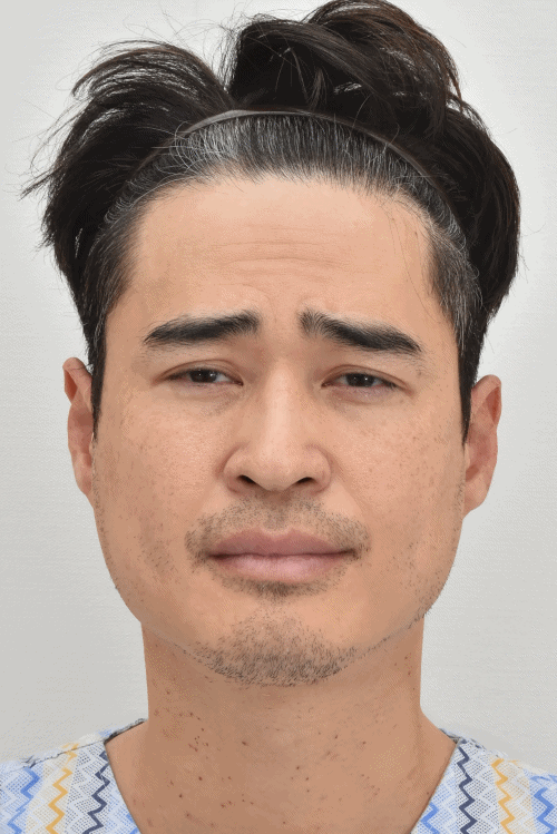 因眼尾下垂导致无意识皱眉的术前照片