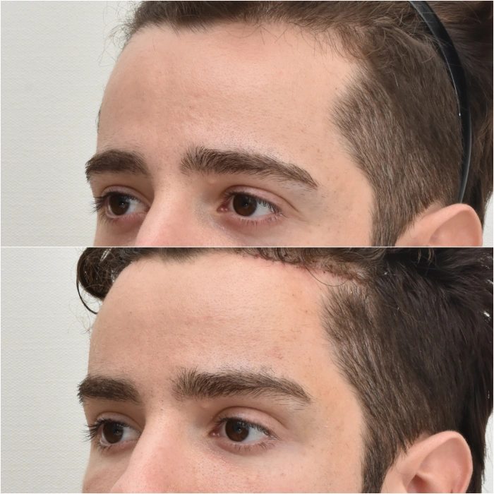 Male temporal brow lift korea
