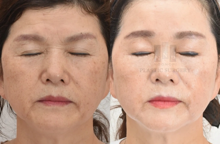 중년 눈꺼풀처짐 수술 전후