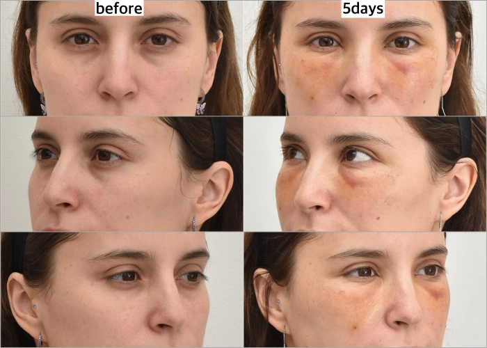 استعادة الحجم، بعد 5 أيام فقط من الإجراء