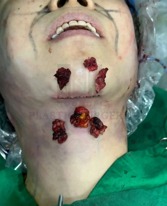 术后效果:本例仅去除少量脂肪与腺体组织