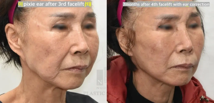 حالة تصحيح شحمة الأذن