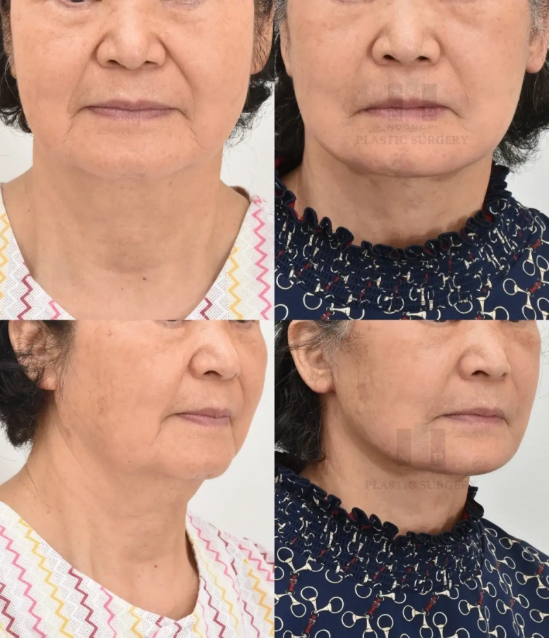 تجميل الوجه قبل وبعد الصورة