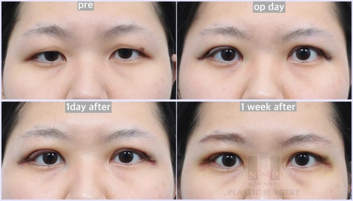 incisional double eyelid before after