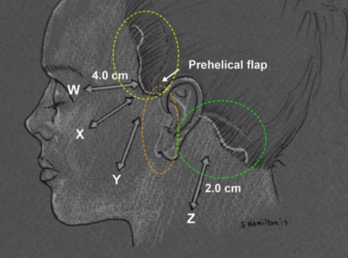 三大核心切口区：太阳穴（黄色）、耳前区（橙色）、耳后区（绿色）