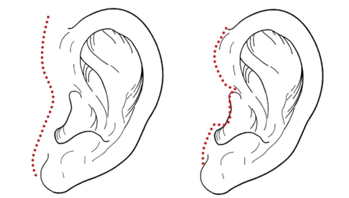 In Front of the Ear Incision in facelift