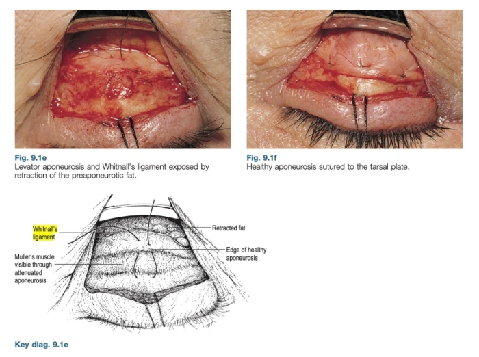 levator aponeurosis advancement for eyelid ptosis surgery